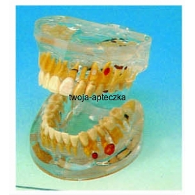 Model - choroby zębów HUG/B10011