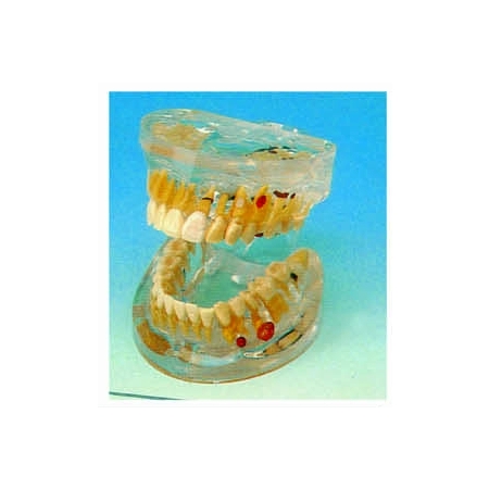 Model - choroby zębów HUG/B10011